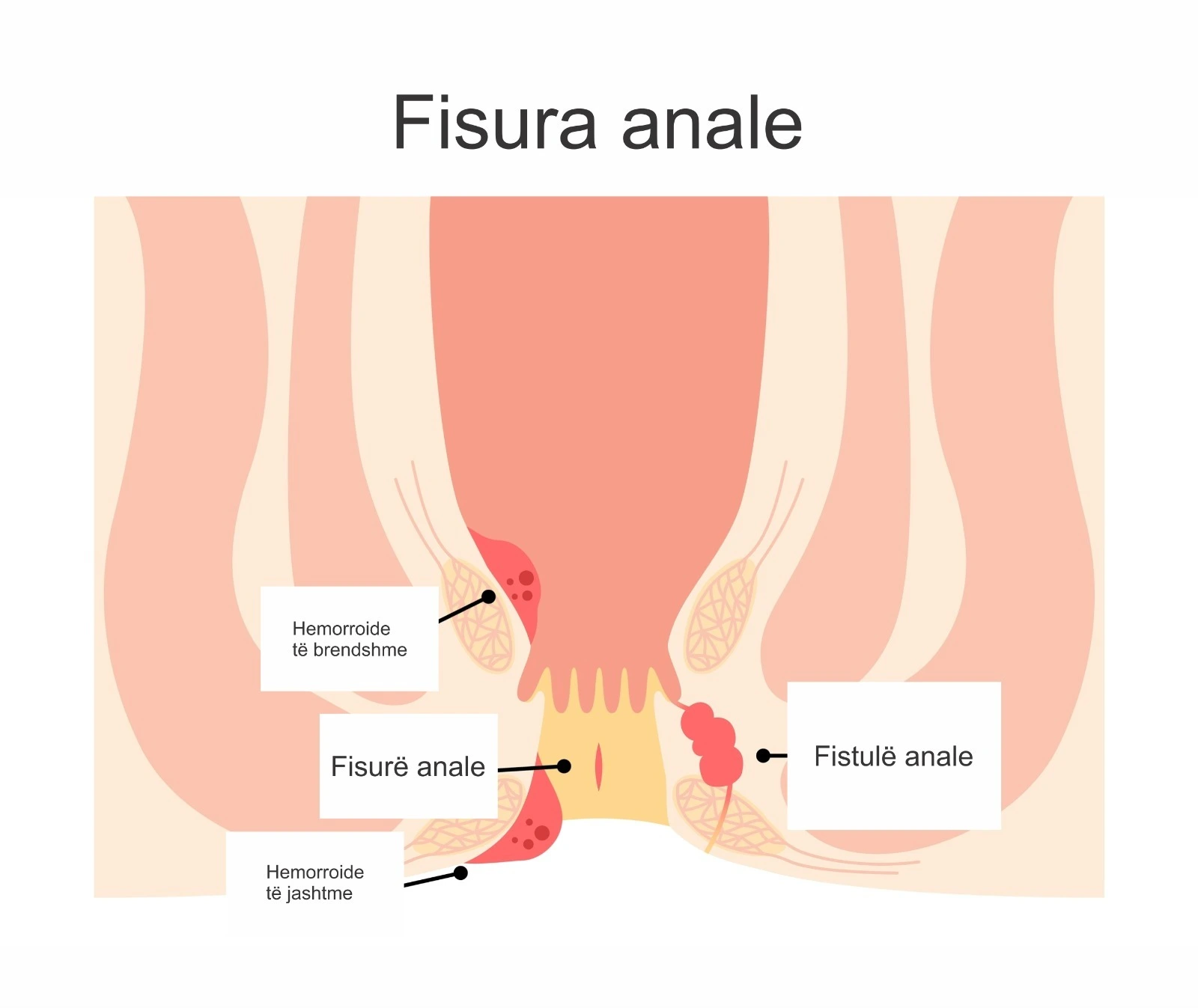Diagram që tregon fisurën anale dhe strukturat përreth, përfshirë hemorroidet dhe fistulën anal